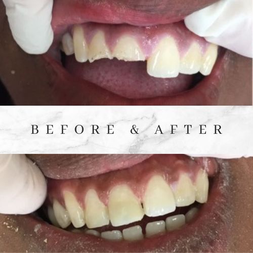 before & after dental implant surgery