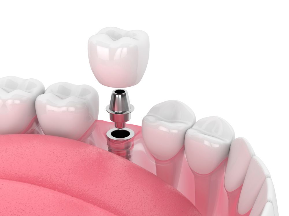 dental-implant.jpg
