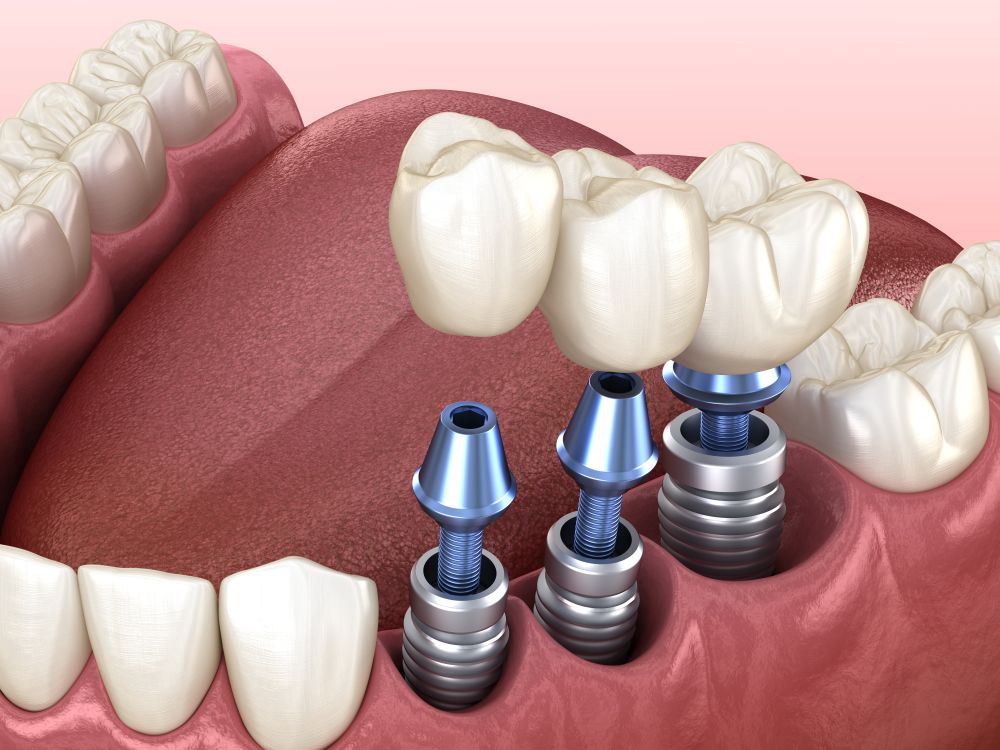 dental-implants.jpg