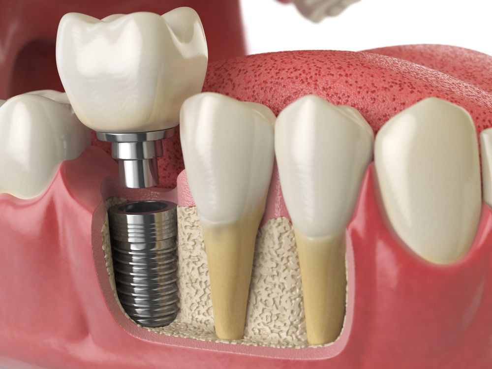 single-dental-implant.jpg