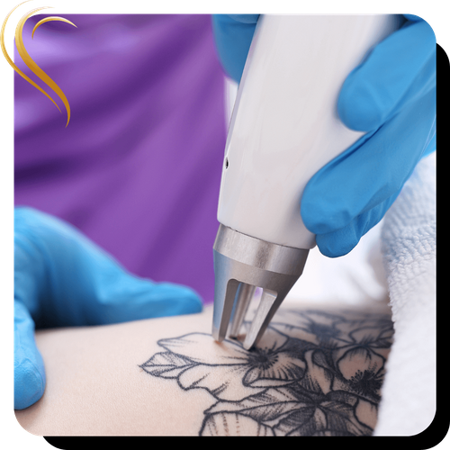 laser tattoo removal in progress laser tattoo removal in progress