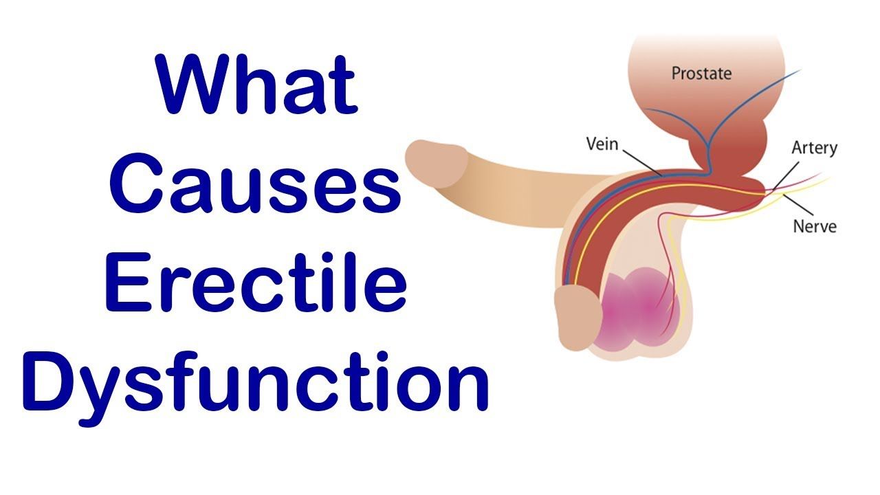 Understanding and Treating Erectile Dysfunction ED Expert