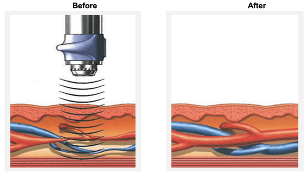 Shockwave-Therapy-and-Acoustic-Therapy-for-ED.png