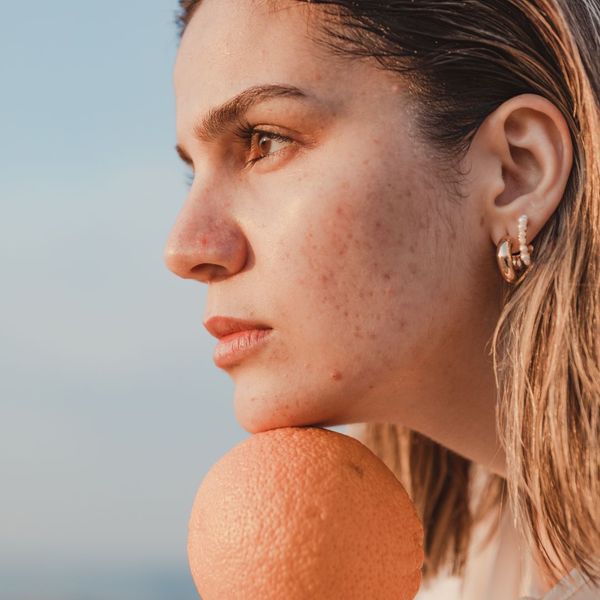 Woman with acne