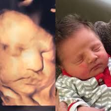 Ultrasound Baby