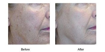 Before and After image of photo rejuvenation Before and After image of photo rejuvenation