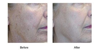 Before and After image of photo rejuvenation