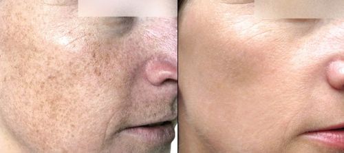 Image of face before and after treatment