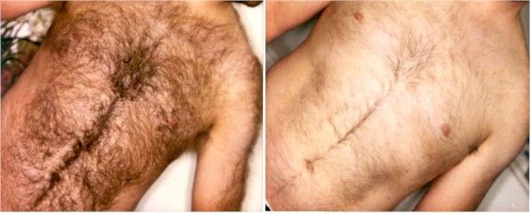 Before and after image of laser hair removal treatment Before and after image of laser hair removal treatment
