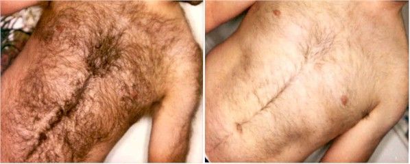 Before and after image of laser hair removal treatment