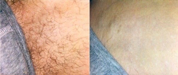 Before and after image of laser hair removal treatment