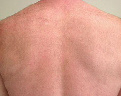 Image of Back after laser hair removal treatment