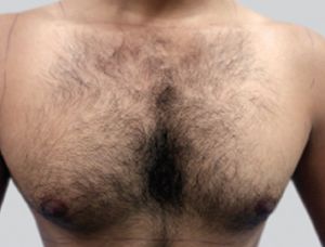 Image of chest before laser hair removal treatment Image of chest before laser hair removal treatment