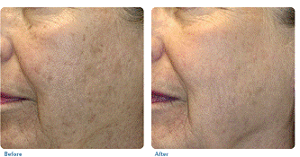 Before and after image of skin tightening