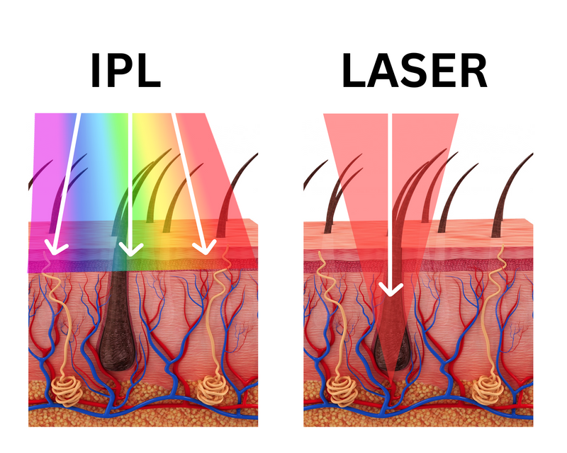 IPL vs Laser .png
