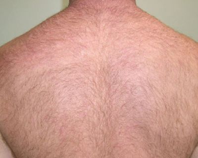Image of Back before laser hair removal treatment