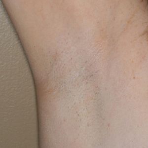 Image of Axilla before laser hair removal treatment Image of Axilla after laser hair removal treatment