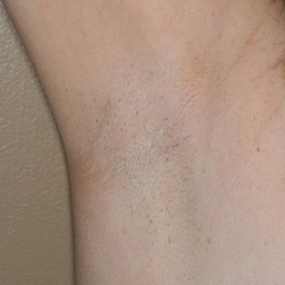 Image of Axilla after laser hair removal treatment