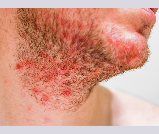 Hair removal for folliculitis suppurativa with Permanent Choice Laser Hair Removal and Electrolysis Centers