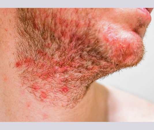 Folliculitis treatment.png