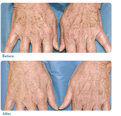 Before and after image of photo rejuvenation
