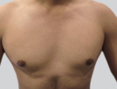 Image of chest after laser hair removal treatment