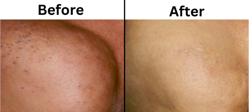 Laser hair removal before and after - Permanent Choice Laser Hair Removal and Electrolysis Centers