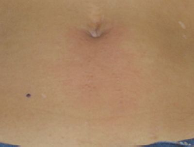 Image of lower abdomen after laser hair removal treatment