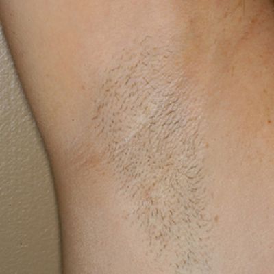 Image of Axilla before laser hair removal treatment