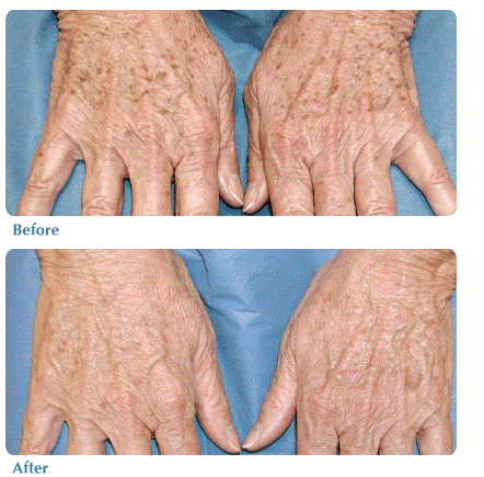 Before and After image of photo rejuvenation
