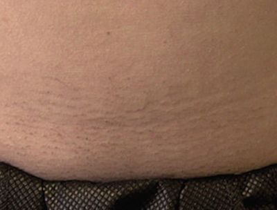 Image of lower abdomen after laser hair removal treatment