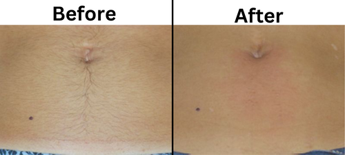 Abdomen Laser hair removal before and after - Permanent Choice Laser Hair Removal and Electrolysis Centers