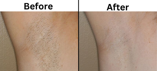 underarm Laser hair removal before and after - Permanent Choice Laser Hair Removal and Electrolysis Centers