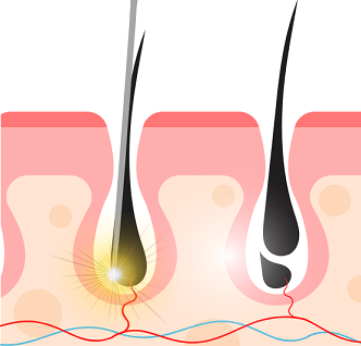 Laser Hair Removal vs Electrolysis | Pulse Light Clinic London