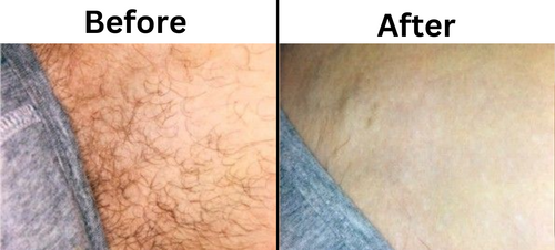 Laser hair removal before and after - Permanent Choice Laser Hair Removal and Electrolysis Centers