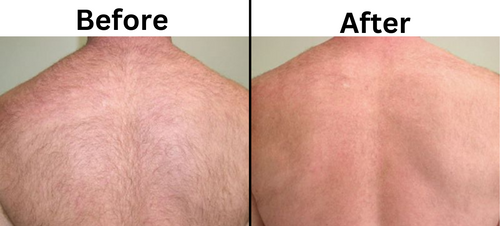 Back Laser hair removal before and after - Permanent Choice Laser Hair Removal and Electrolysis Centers