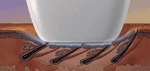 Image of Laser Hair Removal Technology