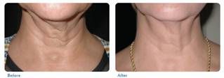 BBL Photorejuvenation before and after - Permanent Choice Laser Hair Removal and Electrolysis Centers