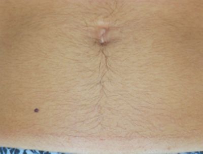 Image of lower abdomen before laser hair removal treatment