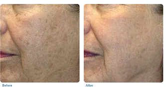 Before and after image of skin tightening Before and after image of skin tightening