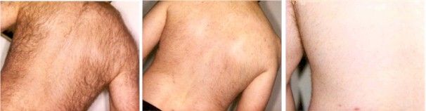Before and after image of laser hair removal treatment Before and after image of laser hair removal treatment