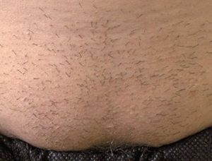Image of lower abdomen before laser hair removal treatment Image of lower abdomen before laser hair removal treatment