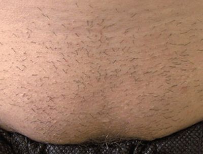 Image of lower abdomen before laser hair removal treatment