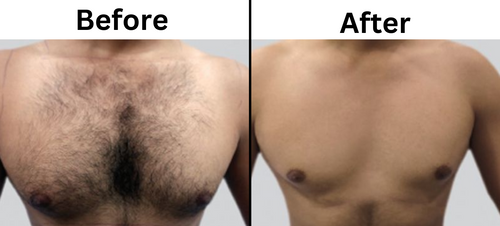 Laser hair removal before and after - Permanent Choice Laser Hair Removal and Electrolysis Centers