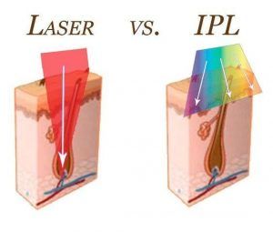 Diagram showing the difference between Laser vs IPL Diagram showing the difference between Laser vs IPL