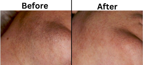 Laser hair removal before and after - Permanent Choice Laser Hair Removal and Electrolysis Centers