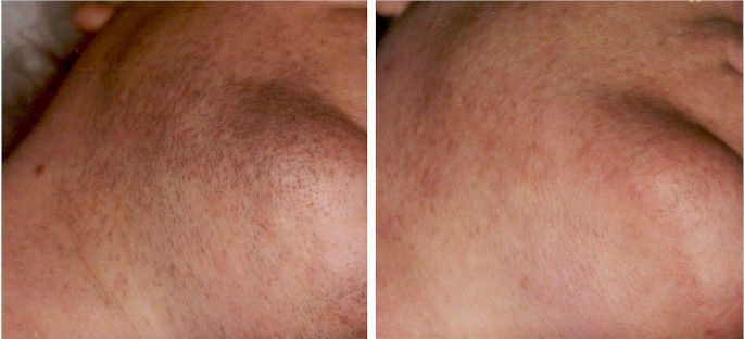 Before and after image of laser hair removal treatment