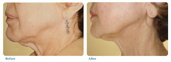 Before and after image of skin tightening