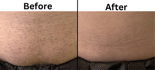 Stomach Laser hair removal before and after - Permanent Choice Laser Hair Removal and Electrolysis Centers