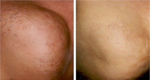 Before and after image of laser hair removal treatment